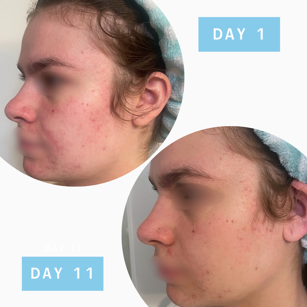 Easey Acne Toning Mist