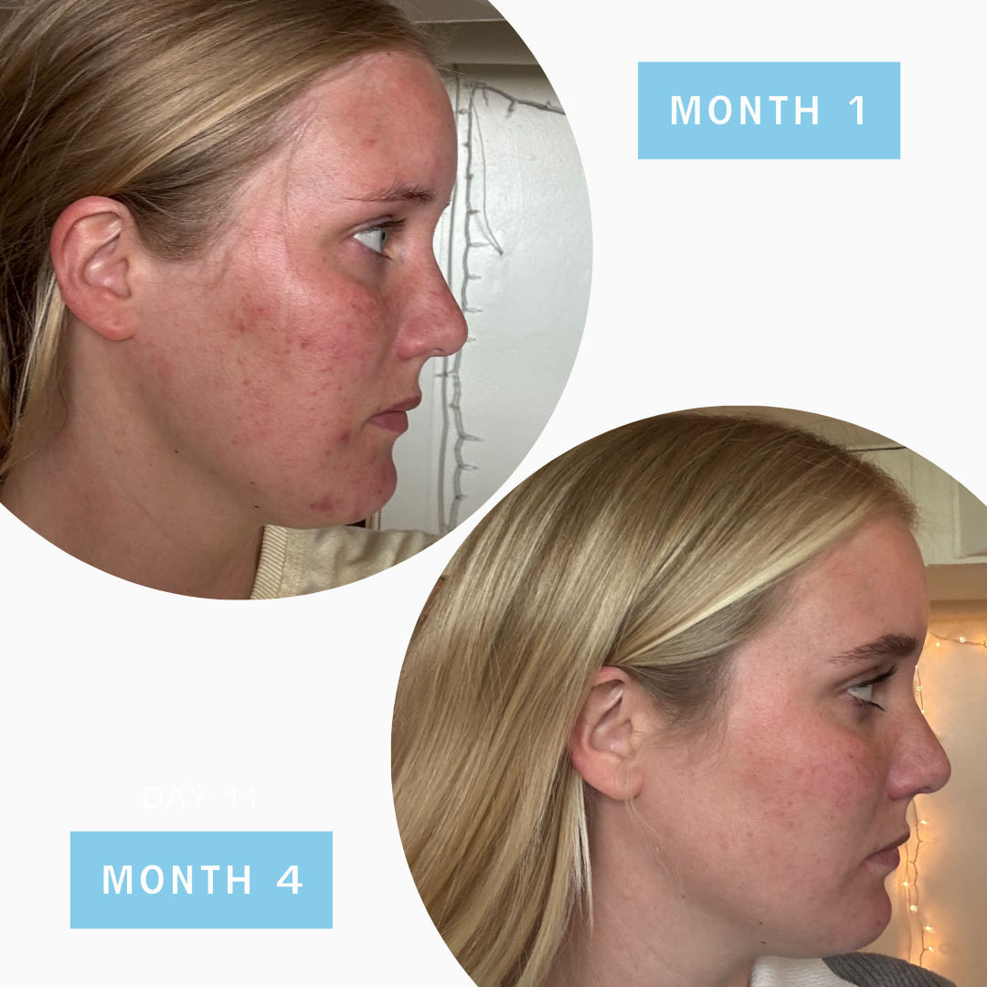 Easey Acne Toning Mist